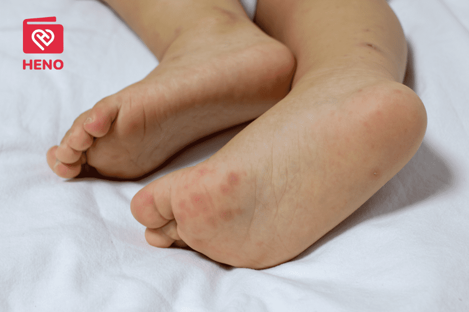 5 dấu hiệu cho thấy trẻ đã mắc bệnh chân tay miệng mà ba mẹ cần lưu ý